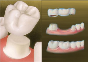 Fixed Partial Dentures